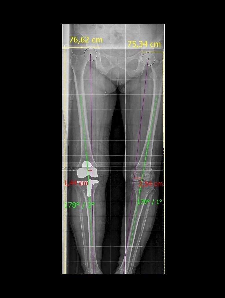 Radiografía — Prótesis total de rodilla (genu varo severo) (1)
