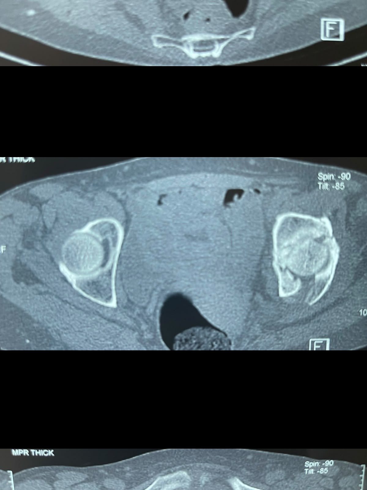 Radiografía — Reconstrucción acetabular y prótesis de cadera (1)